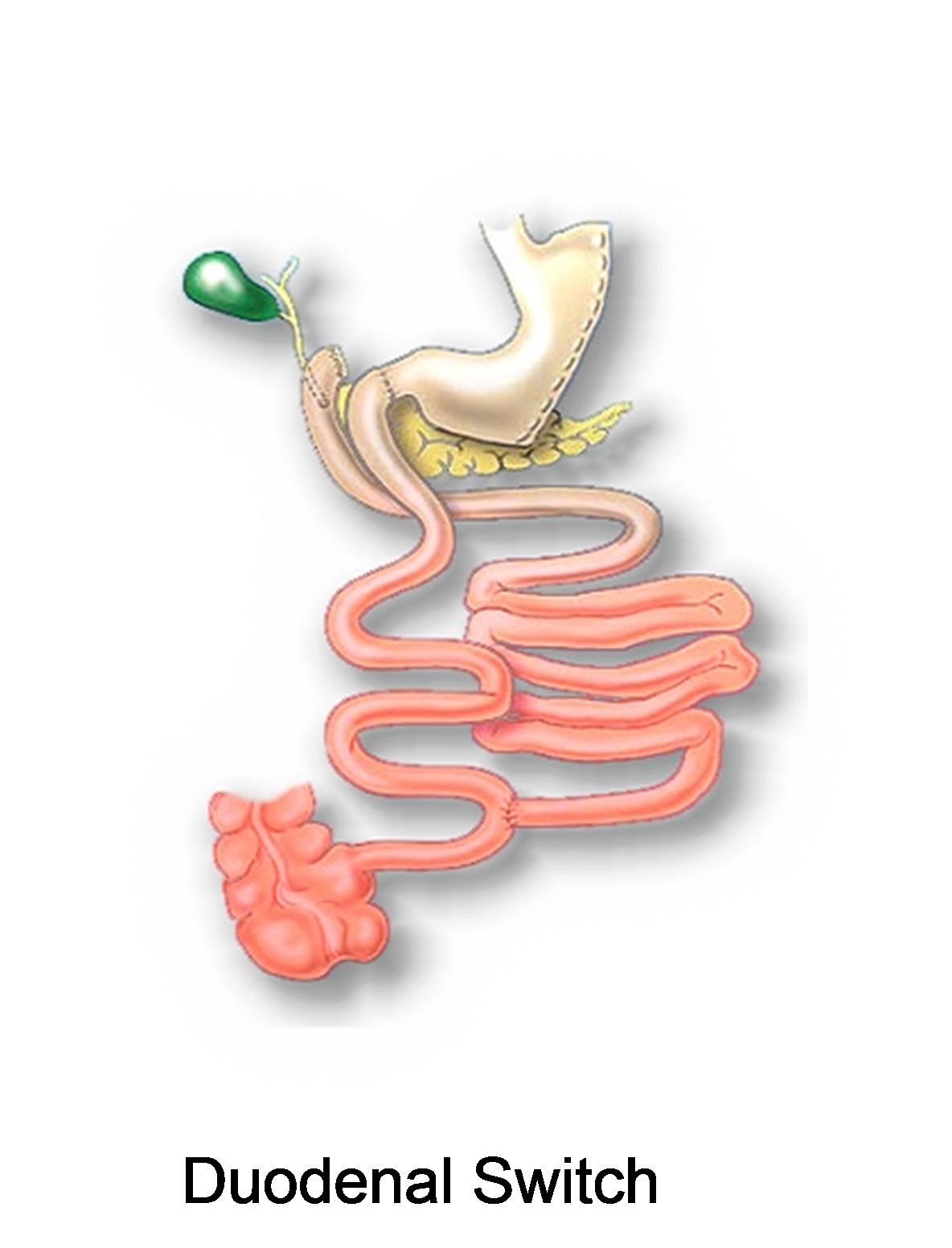 Duodenal switch2