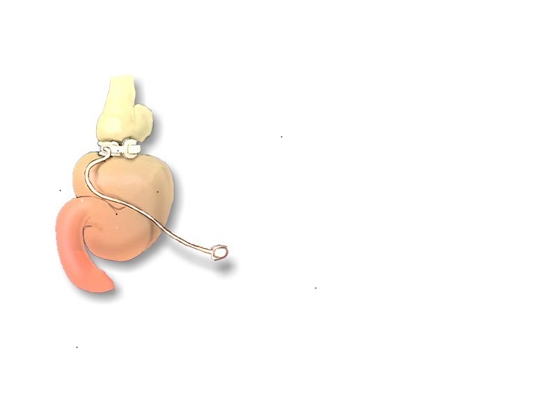 Magenband2