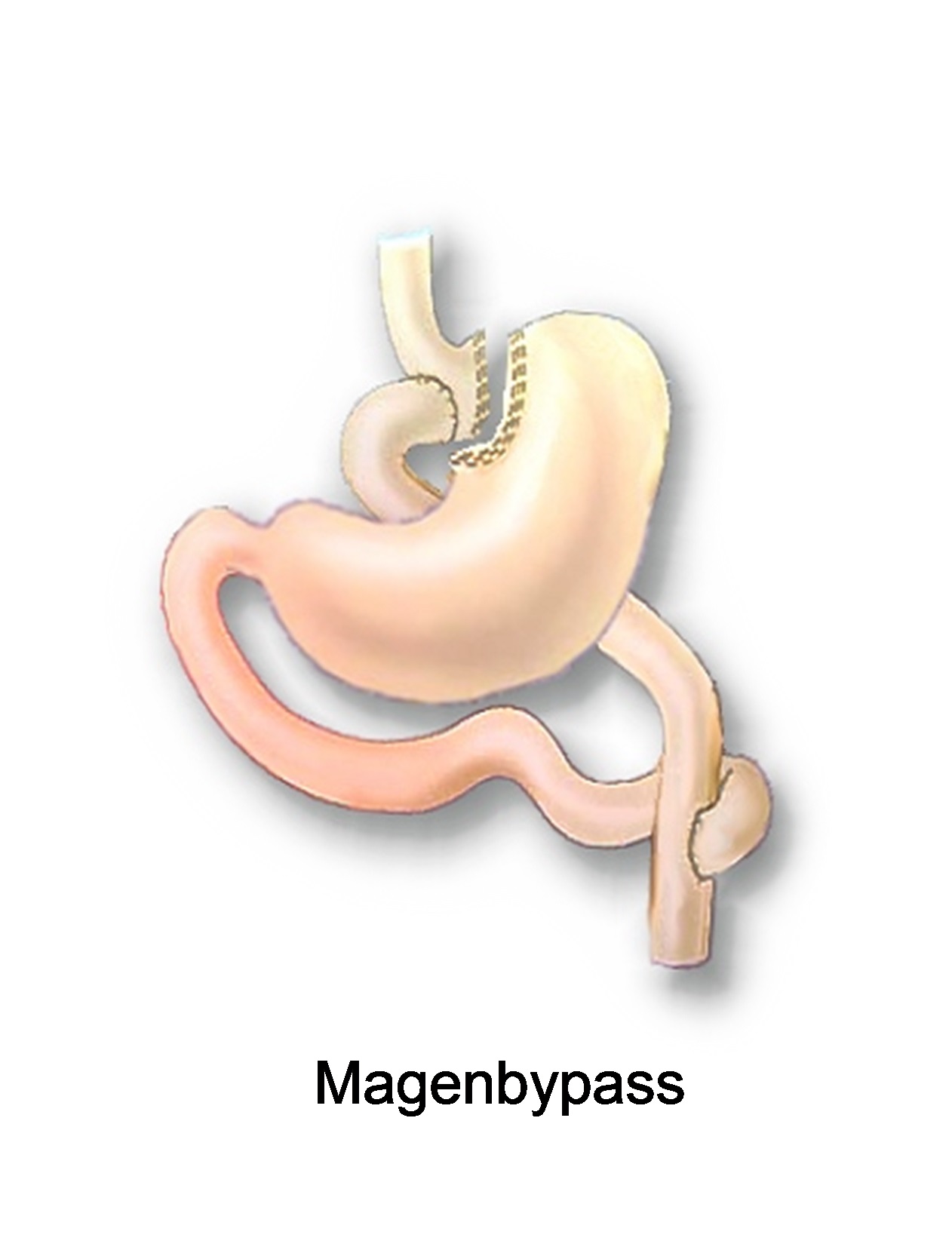 Magenbypass2