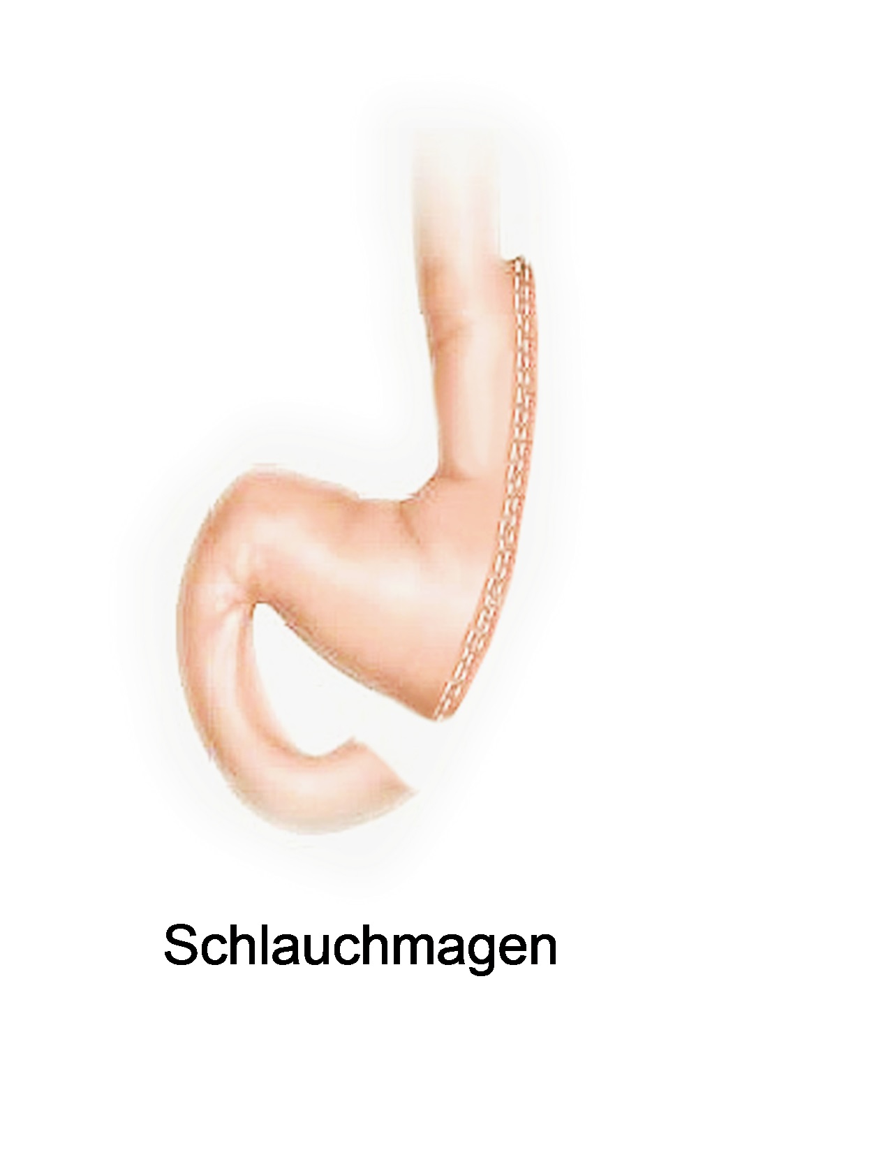 Schlauchmagen2